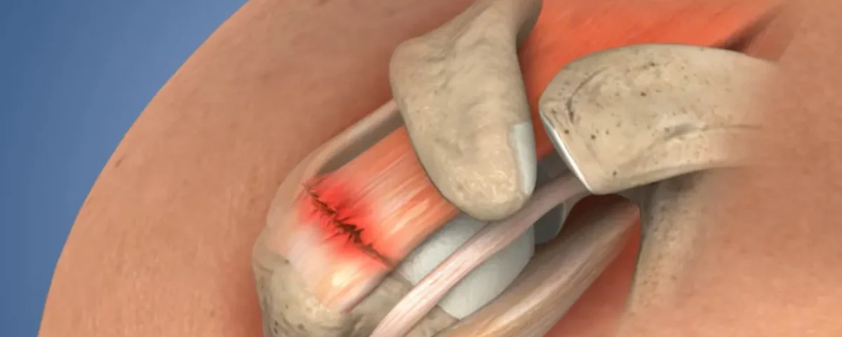 پارگی روتاتور کاف شانه