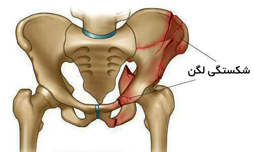 فیزیوتراپی شکستگی لگن